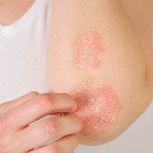 skin allergies and eczema rash