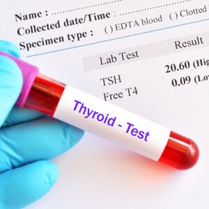 hypothyroidism test results TSH T4 T3