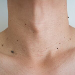 mole signs of insulin resistance pcos