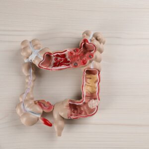 column ulcers and inflammation IBD