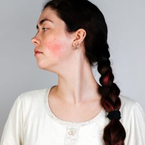 woman inflamed skin psoriasis