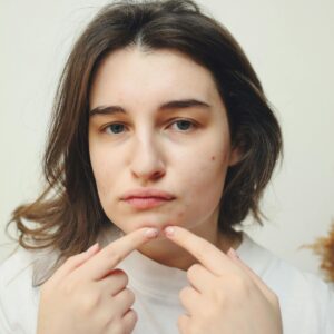 puffy face cortisol high acne