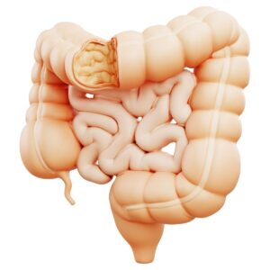 leaky gut healing steps fasting