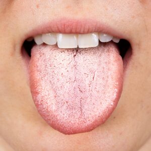 White tongue coating candida infection