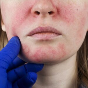 Rosacea glass like skin Astaxanthin skin tone