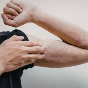 eczema flare irritated skin