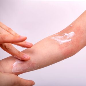 Steroid Creams use for irritated skin eczema hand health risk