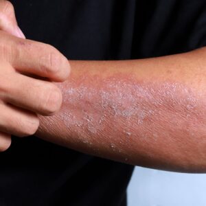 skin allergie and histamine MSM