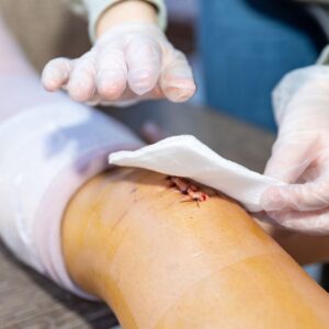 wound healing diabetes leg wound