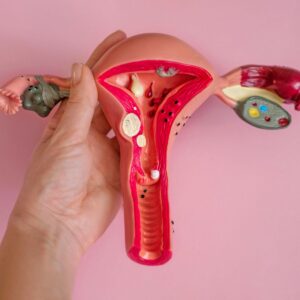 uterine fibroids in woman