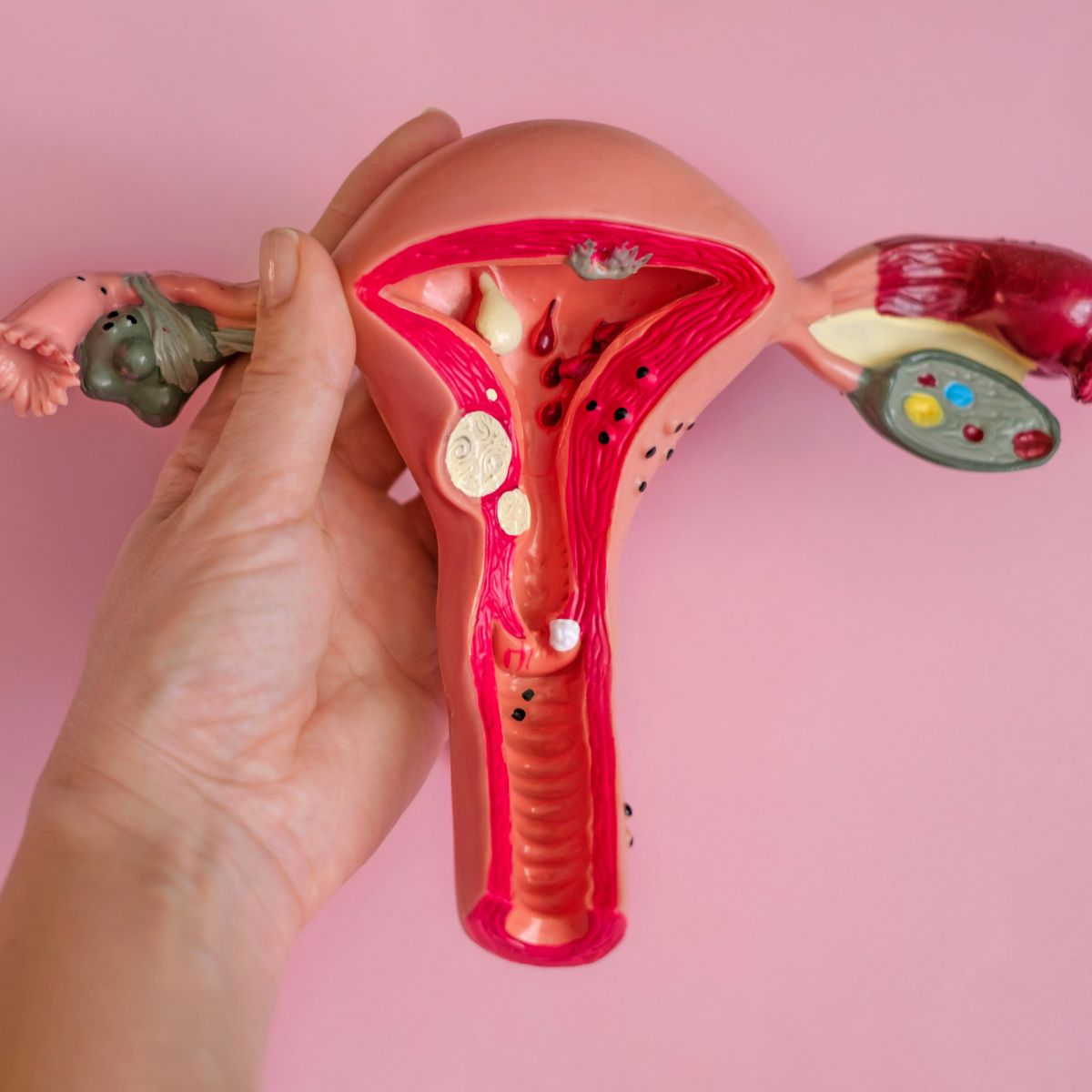 uterine fibroids in woman